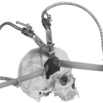 AE-FF262R, YASARGIL SELF-RETAINING RETRACTOR WITH 2 FLEXIBLE ARMS